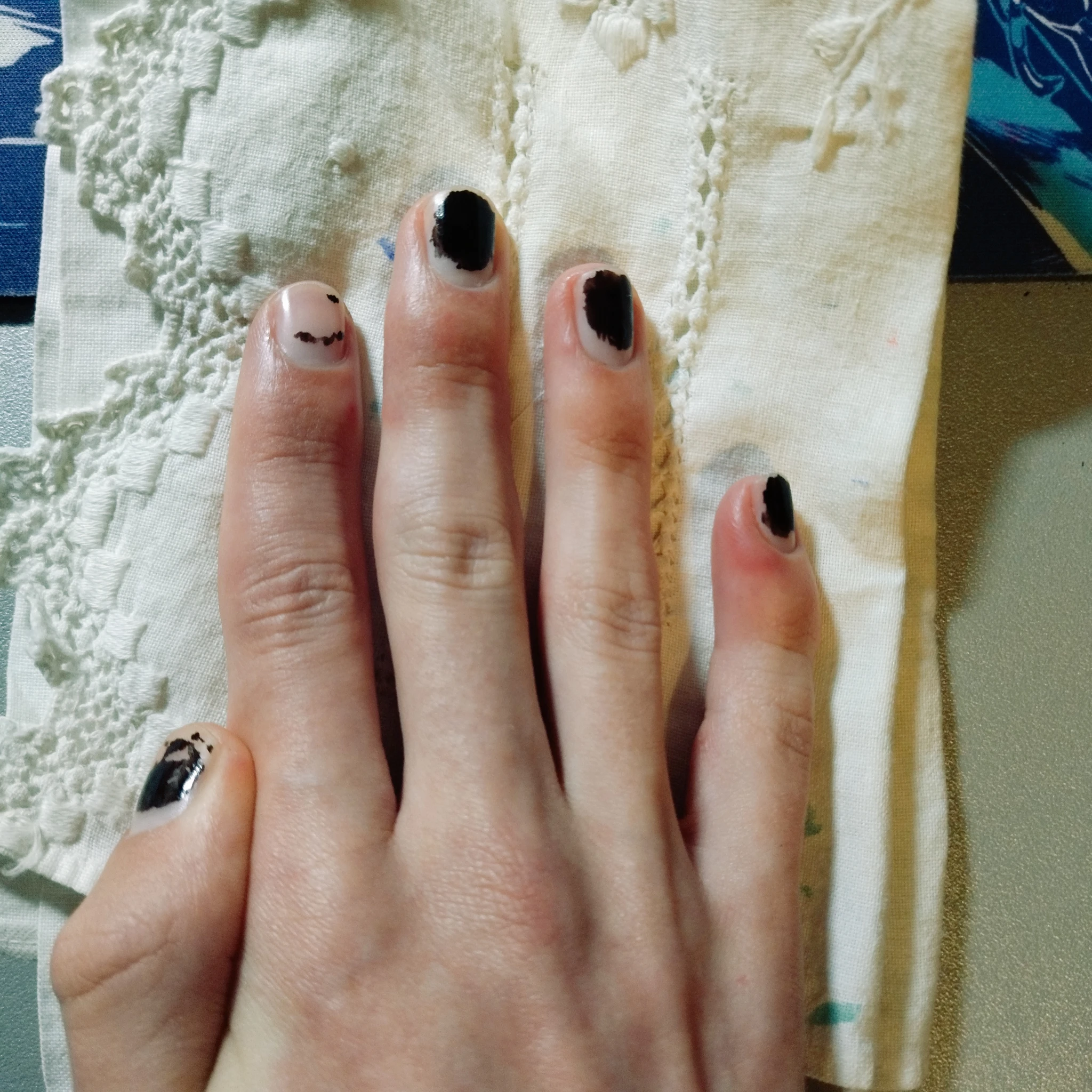 Foto della mia stessa mano destra, una settimana fa, come descritto; lievemente filtrata per non far sembrare la pelle troppo rossa